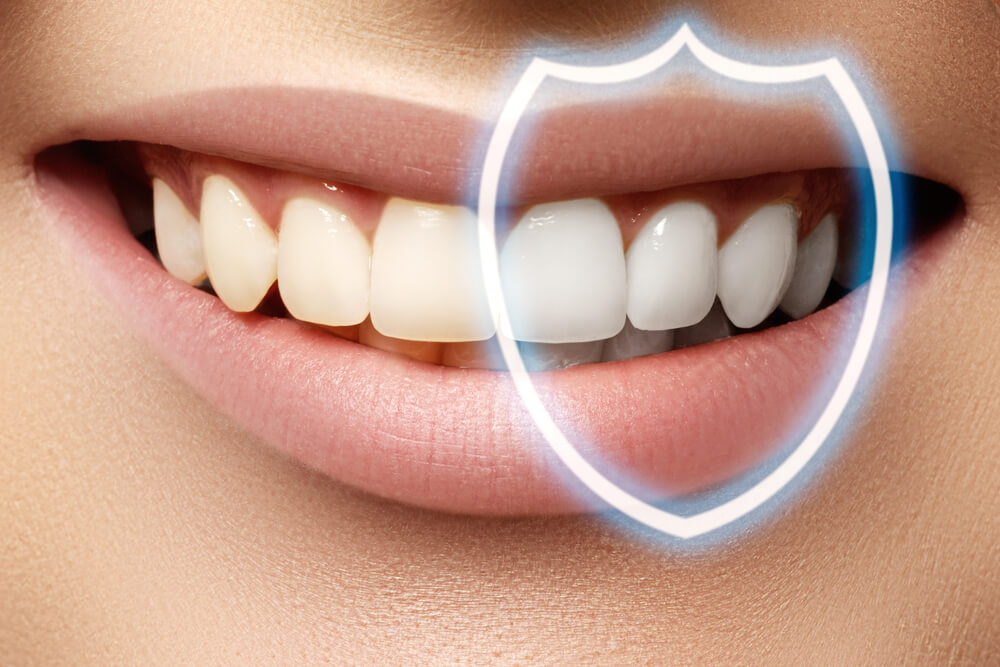 Dental Bonding Resin 